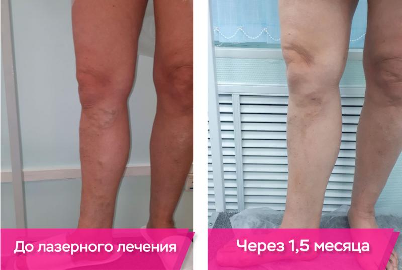 Варикоз на ногах | Варикозное расширение вен у женщин и мужчин